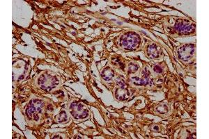 IHC image of ABIN7142837 diluted at 1:400 and staining in paraffin-embedded human breast cancer performed on a Leica BondTM system.