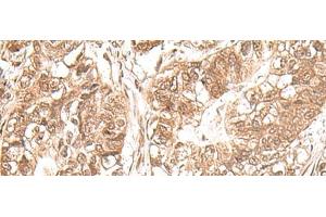 Immunohistochemistry of paraffin-embedded Human gastric cancer tissue using USP16 Polyclonal Antibody at dilution of 1:25(x200) (USP16 抗体)