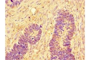 Immunohistochemistry of paraffin-embedded human ovarian cancer using ABIN7160009 at dilution of 1:100 (JNK 抗体  (AA 5-300))
