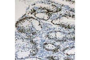 Immunohistochemical analysis of HNF4 alpha/gamma staining in human colon cancer formalin fixed paraffin embedded tissue section. (HNF4 alpha/gamma 抗体)