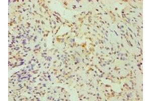 Immunohistochemistry of paraffin-embedded human breast cancer using ABIN7148700 at dilution of 1:100 (CRY1 抗体  (AA 507-586))