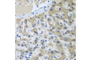 Immunohistochemistry of paraffin-embedded human liver cancer using XPC antibody at dilution of 1:100 (40x lens). (XPC 抗体)