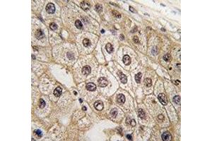 IHC analysis of FFPE human hepatocarcinoma tissue stained with PERK antibody (PERK 抗体  (AA 148-175))