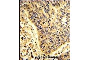 Formalin-fixed and paraffin-embedded human lung carcinoma with MyoGEF Antibody (N-term), which was peroxidase-conjugated to the secondary antibody, followed by DAB staining. (PLEKHG6 抗体  (N-Term))