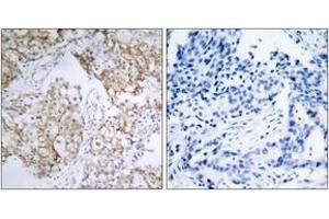 Immunohistochemistry analysis of paraffin-embedded human breast carcinoma, using IGF1R (Phospho-Tyr1161) Antibody. (IGF1R 抗体  (pTyr1161))