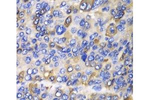 Immunohistochemistry of paraffin-embedded Human liver cancer using CES1 Polyclonal Antibody at dilution of 1:100 (40x lens). (CES1 抗体)