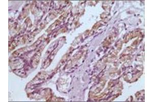 Immunohistochemical analysis of paraffin-embedded human prostate tissues using GSTP1 mouse mAb with DAB staining (GSTP1 抗体)