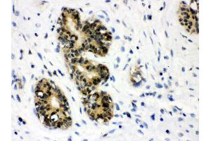Anti- JAB1 Picoband antibody, IHC(P) IHC(P): Human Mammary Cancer Tissue (COPS5 抗体  (AA 8-334))