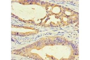 Immunohistochemistry of paraffin-embedded human colon cancer using ABIN7150645 at dilution of 1:100 (DMRTA1 抗体  (AA 201-504))
