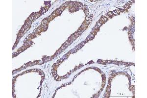 IHC analysis of Carbonic Anhydrase 9/CA9 using anti-Carbonic Anhydrase 9/CA9 antibody (ABIN7600076). (CA9 抗体  (AA 146-414))
