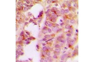 Immunohistochemical analysis of IRS1 staining in human breast cancer formalin fixed paraffin embedded tissue section. (IRS1 抗体  (Center))