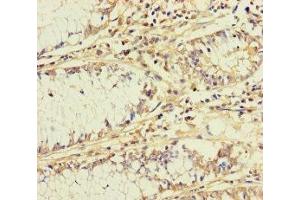 Immunohistochemistry of paraffin-embedded human colon cancer using ABIN7145543 at dilution of 1:100 (BCMO1 抗体  (AA 1-300))