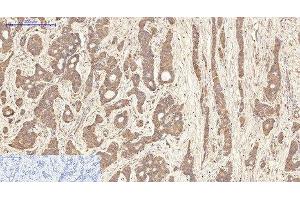 Immunohistochemistry of paraffin-embedded Human liver cancer tissue using AQP4 Monoclonal Antibody at dilution of 1:200. (Aquaporin 4 抗体)