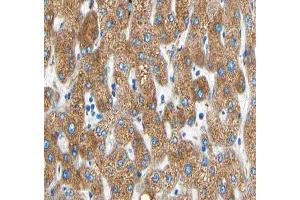 ABIN6266594 at 1/100 staining human liver carcinoma tissue sections by IHC-P. (MMP19 抗体  (N-Term))