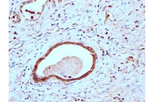 IHC image of ABIN7147892 diluted at 1:200 and staining in paraffin-embedded human gastric cancer performed on a Leica BondTM system. (Claudin 18 抗体  (AA 196-261))