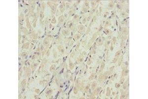 Immunohistochemistry of paraffin-embedded human gastric cancer using ABIN7144963 at dilution of 1:100 (DDX11 抗体  (AA 1-220))