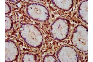 IHC image of ABIN7154840 diluted at 1:150 and staining in paraffin-embedded human gastric cancer performed on a Leica BondTM system. (HAX1 抗体  (AA 2-250))