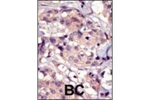 Immunohistochemistry (Paraffin-embedded Sections) (IHC (p)) image for anti-Platelet Derived Growth Factor Receptor alpha (PDGFRA) (AA 1048-1077), (C-Term) antibody (ABIN392022)