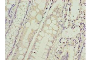 Immunohistochemistry of paraffin-embedded human colon cancer using ABIN7155160 at dilution of 1:100 (HIGD1B 抗体  (AA 1-29))