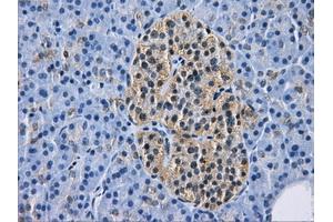 Immunohistochemical staining of paraffin-embedded Adenocarcinoma of breast tissue using anti-HDAC10 mouse monoclonal antibody. (HDAC10 抗体)
