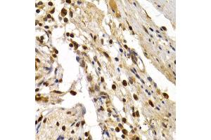 Immunohistochemistry of paraffin-embedded human colon damage using TFDP1 antibody at dilution of 1:200 (400x lens). (DP1 抗体)