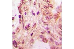 Immunohistochemical analysis of SF2 staining in human lung cancer formalin fixed paraffin embedded tissue section. (SRSF1 抗体)