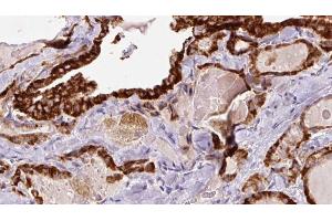 ABIN6267189 at 1/100 staining Human thyroid cancer tissue by IHC-P. (SYN1 抗体  (pSer605))