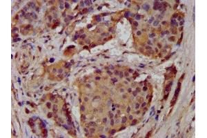 IHC image of ABIN7143000 diluted at 1:300 and staining in paraffin-embedded human pancreatic cancer performed on a Leica BondTM system. (ACCN1 抗体  (AA 197-345))