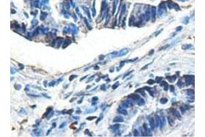 Immunohistochemical analysis of paraffin-embedded human colon carcinoma showing cytoplasmic staining with ACAD9 polyclonal antibody  at a 1 : 100 dilution.