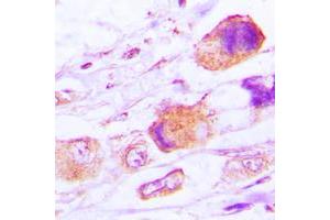 Immunohistochemical analysis of MRPL15 staining in human lung cancer formalin fixed paraffin embedded tissue section. (MRPL15 抗体  (Center))