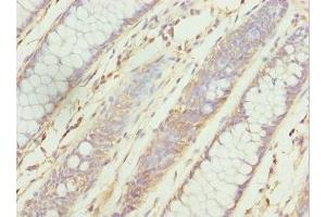 Immunohistochemistry of paraffin-embedded human colon cancer using ABIN7176126 at dilution of 1:100 (ZNF169 抗体  (AA 1-85))