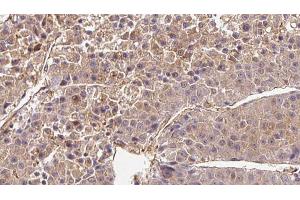 ABIN6272720 at 1/100 staining Human liver cancer tissue by IHC-P. (OR2B6 抗体  (Internal Region))