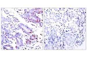 Immunohistochemical analysis of paraffin-embedded human breast carcinoma tissue using STAT1 (Ab-701) antibody (E021044). (STAT1 抗体)
