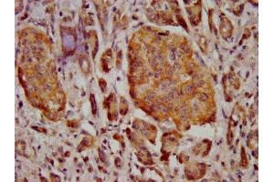 IHC image of ABIN7159545 diluted at 1:400 and staining in paraffin-embedded human pancreatic cancer performed on a Leica BondTM system. (MT3 抗体  (AA 1-68))