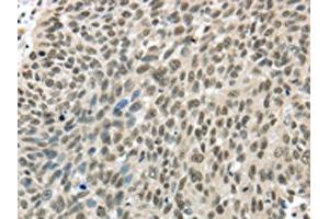The image on the left is immunohistochemistry of paraffin-embedded Human lung cancer tissue using ABIN7131308(TBL1Y Antibody) at dilution 1/20, on the right is treated with fusion protein. (TBL1Y 抗体)