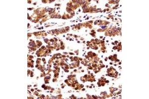 Immunohistochemistry analysis in formalin fixed and paraffin embedded human lung adenocarcinoma reacted with ORC3 / LATHEO Antibody (N-term) followed which was peroxidase conjugaed to the secondary antibody and followed by DAB staining. (ORC3 抗体  (N-Term))