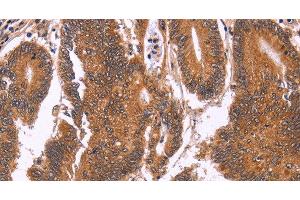 Immunohistochemistry of paraffin-embedded Human colon cancer tissue using CDC37L1 Polyclonal Antibody at dilution 1:60 (CDC37L1 抗体)