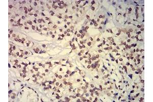 Immunohistochemical analysis of paraffin-embedded bladder cancer tissues using EHMT2 mouse mAb with DAB staining.