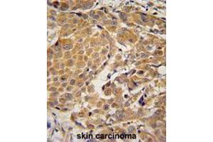 AWAT2 Antibody (C-term) immunohistochemistry analysis in formalin fixed and paraffin embedded human skin carcinoma followed by peroxidase conjugation of the secondary antibody and DAB staining. (AWAT2 抗体  (C-Term))