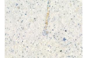 ABIN6260701 and ABIN6278258 at 1/100 staining human astrocytoma by IHC-P.