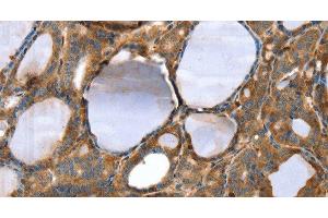 Immunohistochemistry of paraffin-embedded Human thyroid cancer tissue using TAGLN Polyclonal Antibody at dilution 1:30 (Transgelin 抗体)
