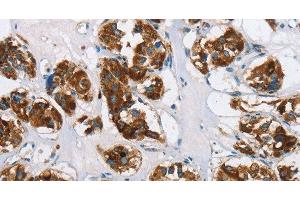 Immunohistochemistry of paraffin-embedded Human thyroid cancer using HINT2 Polyclonal Antibody at dilution of 1:50 (HINT2 抗体)