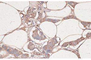 Immunohistochemistry of paraffin-embedded Human breast cancer using LAMC1 Polyclonal Antibody at dilution of 1:100 (40x lens). (Laminin gamma 1 抗体)