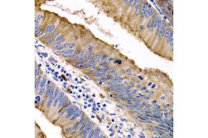 Immunohistochemistry of paraffin-embedded human colon cancer using IL9 antibody (ABIN5974970) at dilution of 1/200 (40x lens). (IL-9 抗体)