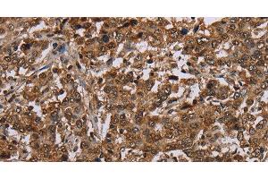 Immunohistochemistry of paraffin-embedded Human liver cancer using TBX5 Polyclonal Antibody at dilution of 1:35 (T-Box 5 抗体)