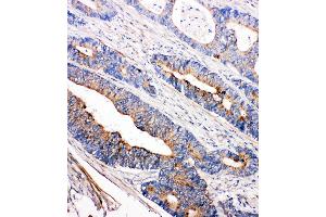Anti-Tec antibody, IHC(P) IHC(P): Human Intestinal Cancer Tissue (NR4A3 抗体  (C-Term))