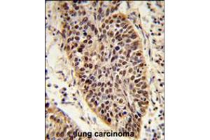 Formalin-fixed and paraffin-embedded human lung carcinoma reacted with XPA Antibody , which was peroxidase-conjugated to the secondary antibody, followed by DAB staining. (XPA 抗体  (C-Term))