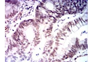 Immunohistochemical analysis of paraffin-embedded colon cancer tissues using MLH1 mouse mAb with DAB staining.