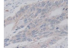 Detection of LACTb in Human Colorectal cancer Tissue using Polyclonal Antibody to Lactamase Beta (LACTb) (LACTB 抗体  (AA 313-547))