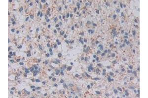 Detection of TOP3 in Human Glioma Tissue using Polyclonal Antibody to Topoisomerase III (TOP3) (TOP3 抗体  (AA 35-179))